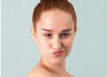SVR Sebiaclear : ma routine In & Out  pour lutter contre les boutons d’acné